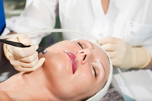 microdermabrasion-treatment